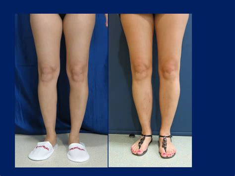Estetica Europe Curved Lower Legs And Calf Implants Ru