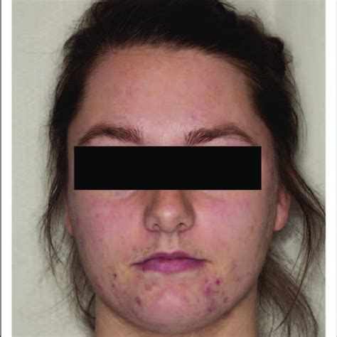 Cushings Syndrome Manifestations On A 10 Year Old A Moon Face