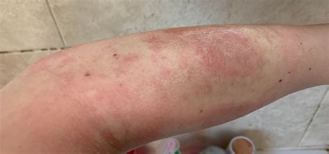 What Might This Rash On My Forearm Be W Pictures Dermatologyquestions