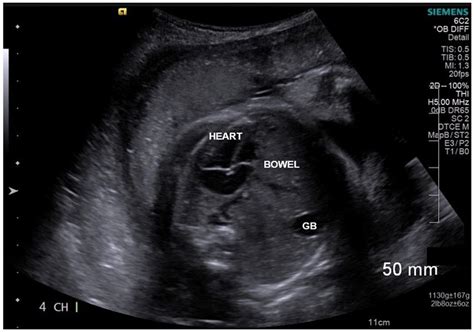 Sonographic Evaluation Of A Fetal Right Sided Diaphragmatic Hernia A