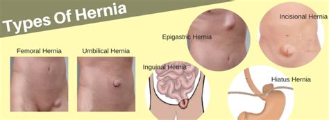 Are There Different Types Of Hernia Springfield Wellness Centre Dr Maran