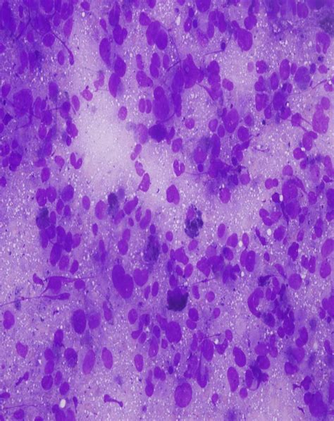 Pathology Outlines Melanoma