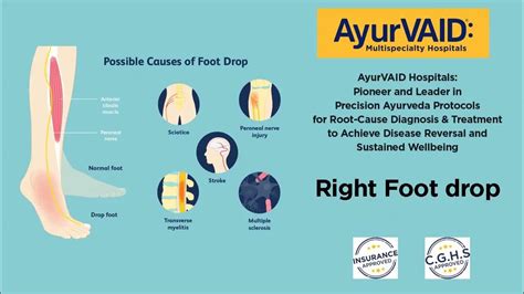 Ayurveda Management For Right Foot Drop Neurological Condition