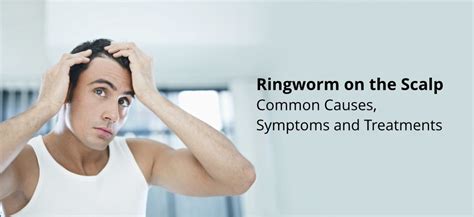 Ringworm On Scalp Tinea Capitis Symptoms Causes Treatments And