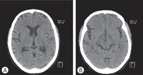 The Non Contrast Head Ct Scan Performed On The Day Of A Open I