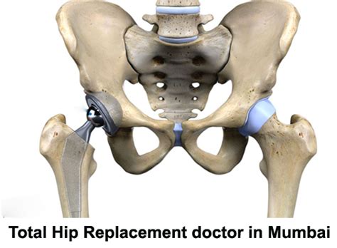 Total Hip Replacement Doctor Mumbai Dr Kunal Patel