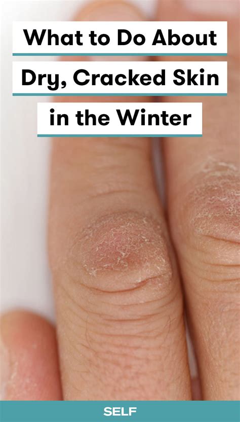 What To Do About Dry Cracked Skin In The Winter Cracked Skin Dry