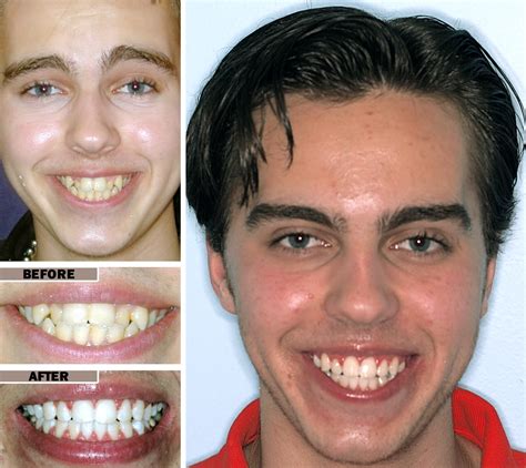 List Pictures Pictures Of Braces On Teeth Before And After Sharp