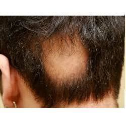 New insights into the pathogenesis and mechanism of hair loss. Alopecia Areata Treatment in Salt Lake City, Kolkata | ID ...