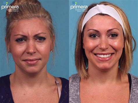 Botox Before After Ideas Plastic Surgery Botox Before And After My
