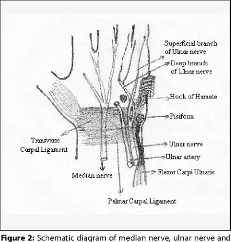 Figure 2 From Ulnar Nerve Entrapment In Guyons Canal Due To Recurrent