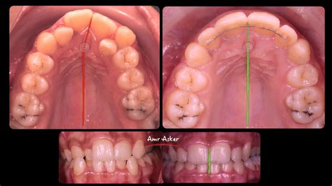 Step By Step Orthodontic Space Opening For Completely Blocked Lateral