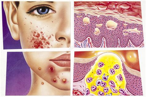 Eczema And Acne Illustration Stock Image C0508226 Science Photo