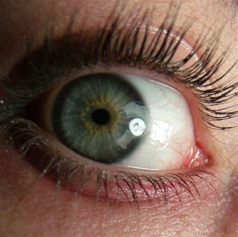 Golden Ring On Cerulean Iris Central Heterochromia Eyes Gray Eyes