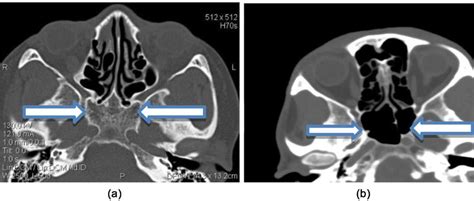 Ct In Bone Window In Axial Cuts Shows Comparison Of Case 1 A