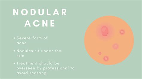 The 8 Types Of Acne And How To Treat Them Goodglow