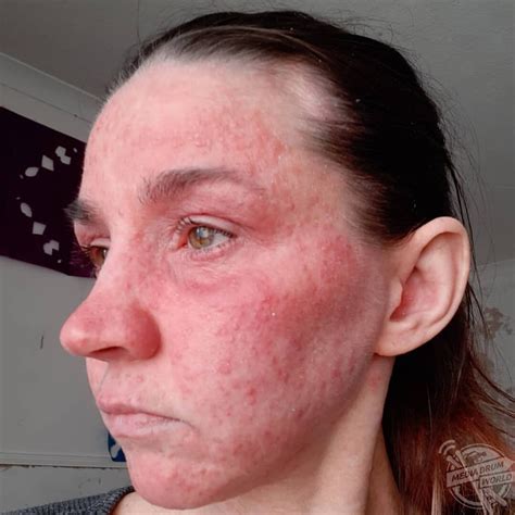 This Womans Skin Has Been Damaged So Much By Steroid Creams That