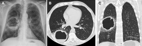 Lung Abscess In An Immunocompromised Patient Clinical Presentation And
