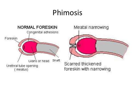 Phimosis Anatomy