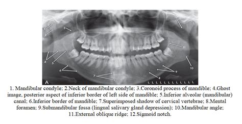 Normal Anatomic Landmarks On Panoramic Radiograph Dental Care