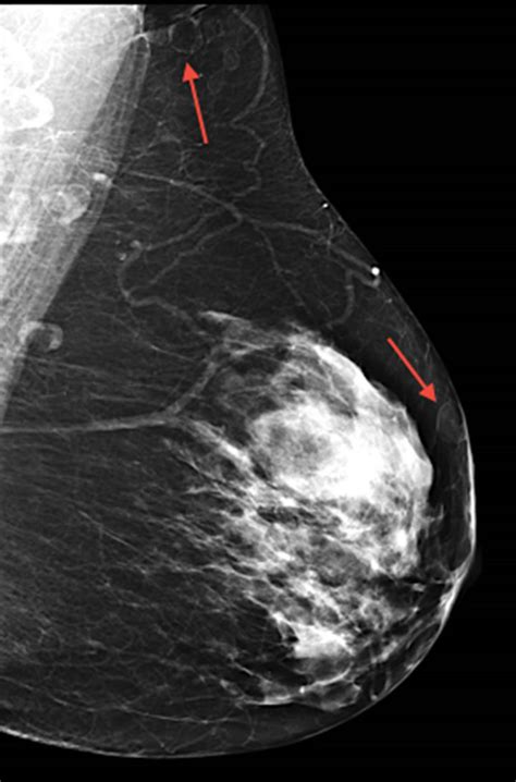 Mammographic Features Of Hidradenitis Suppurativa