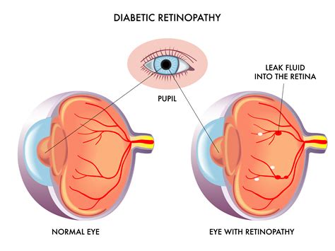 Diabetic Eye Disease Mccrystal Opticians Armagh Award Winning