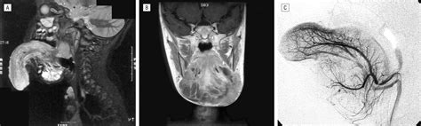Management Of A Giant Lymphatic Malformation Of The Tongue Congenital