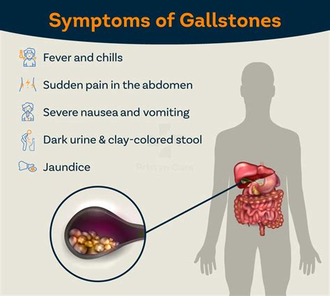 How To Get Rid Of Gallstones Without Surgery Investigationsupply