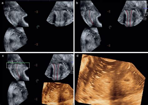 three‐dimensional ultrasound and magnetic resonance imaging assessment of cervix and vagina in