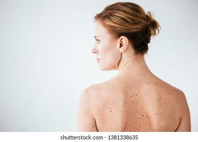 Attractive Naked Woman Skin Sickness On