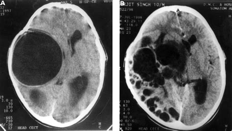 Multiple Hydatid Cysts Of The Brain After Surgery Journal Of