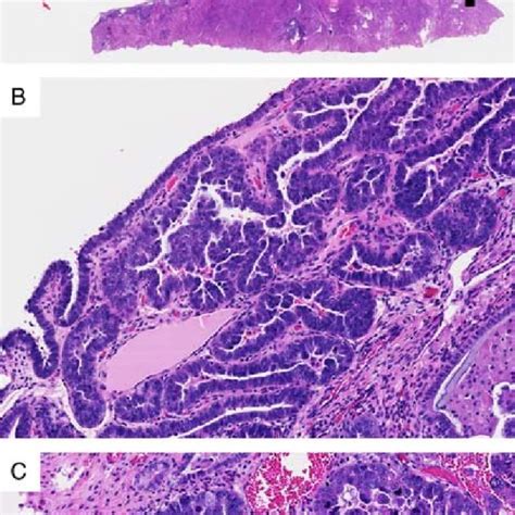 Serous Endometrial Intraepithelial Carcinoma Seic Localized To A Download Scientific Diagram