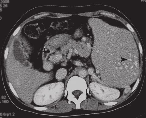 Non Enhanced Abdominal Ct Scan Showing Massive Splenomegaly With
