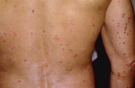 Guttate Psoriasis Causes Symptoms Treatment Guttate Psoriasis