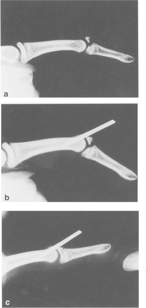 Treatment Of Mallet Finger Fractures By The Extension Block K Wire