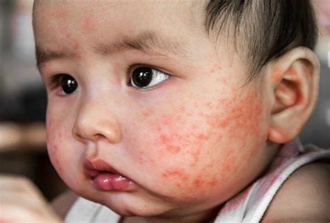 Baby Acne And Rashes 5 Common Types And Their Proper Treatment