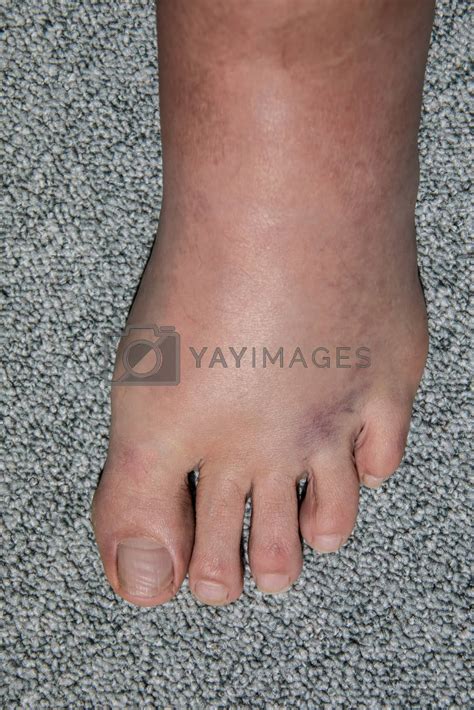 Severe Swelling And Hematoma Of The Left Foot After Bending And By Dr