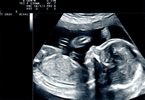 Ultraschallbild Des Babys Premium Foto