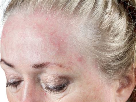 8 Reasons Why You Get Rashes On Scalp
