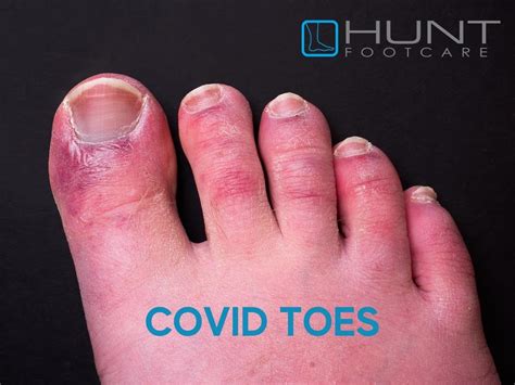 Covid Toes What To Look For And Duration Hunt Footcare