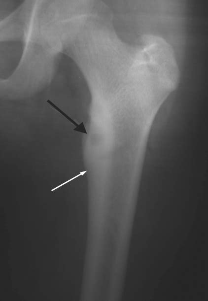 Osteoid Osteoma Plain Radiograph Shows A Typical Metad Open I