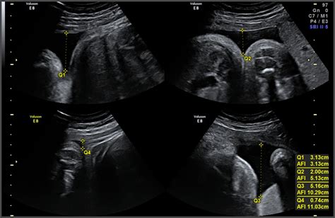 38 weeks ultrasound