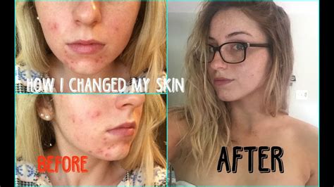 5 Tips On How I Changed My Dry And Acne Prone Skin Youtube