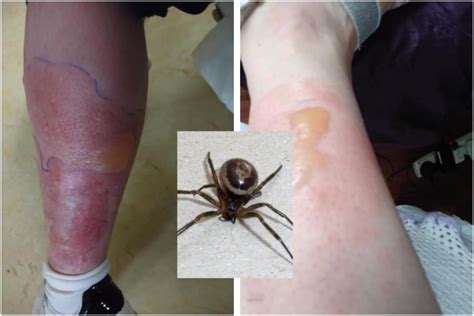 Insect Expert Warns Of Dangers Of Noble False Widow Spiders After Two