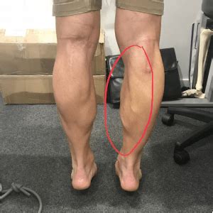 How To Rehab A Torn Gastrocnemius