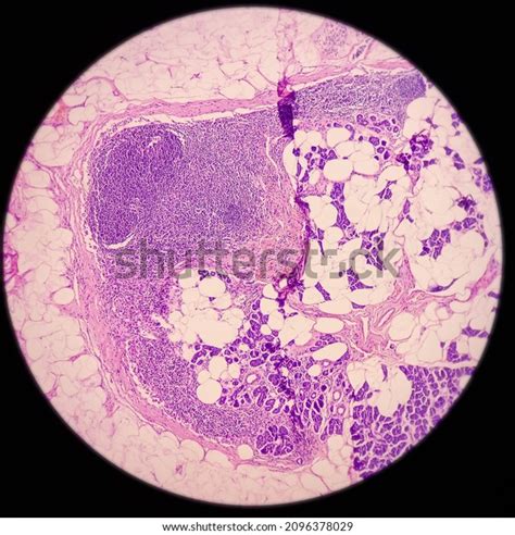 Parotid Tumor Pleomorphic Adenoma Benign Neoplasm Stock Photo