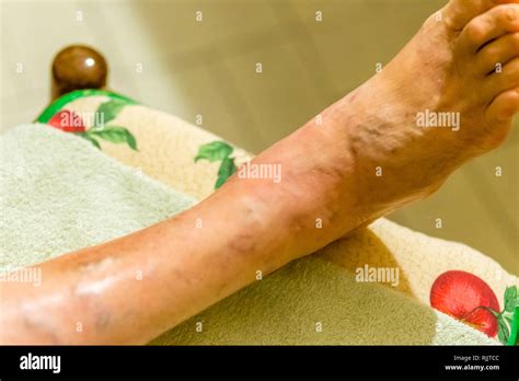 Woman Foot Infection Hi Res Stock Photography And Images Alamy