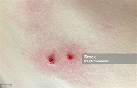 Two Bite Wounds And A Red Mark On The Abdomen Caused By A Dog Bite A