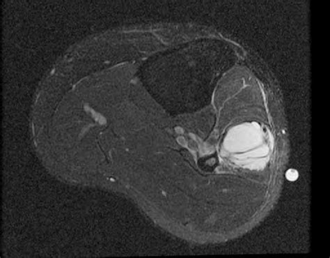 A Ruptured Peroneal Ganglion Cyst T2 Fatsaturated Axial Mri Shows A