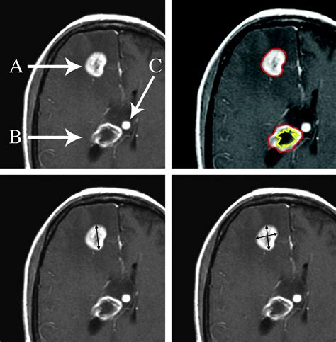 Brain Tumor Imaging In Clinical Trials American Journal Of Neuroradiology